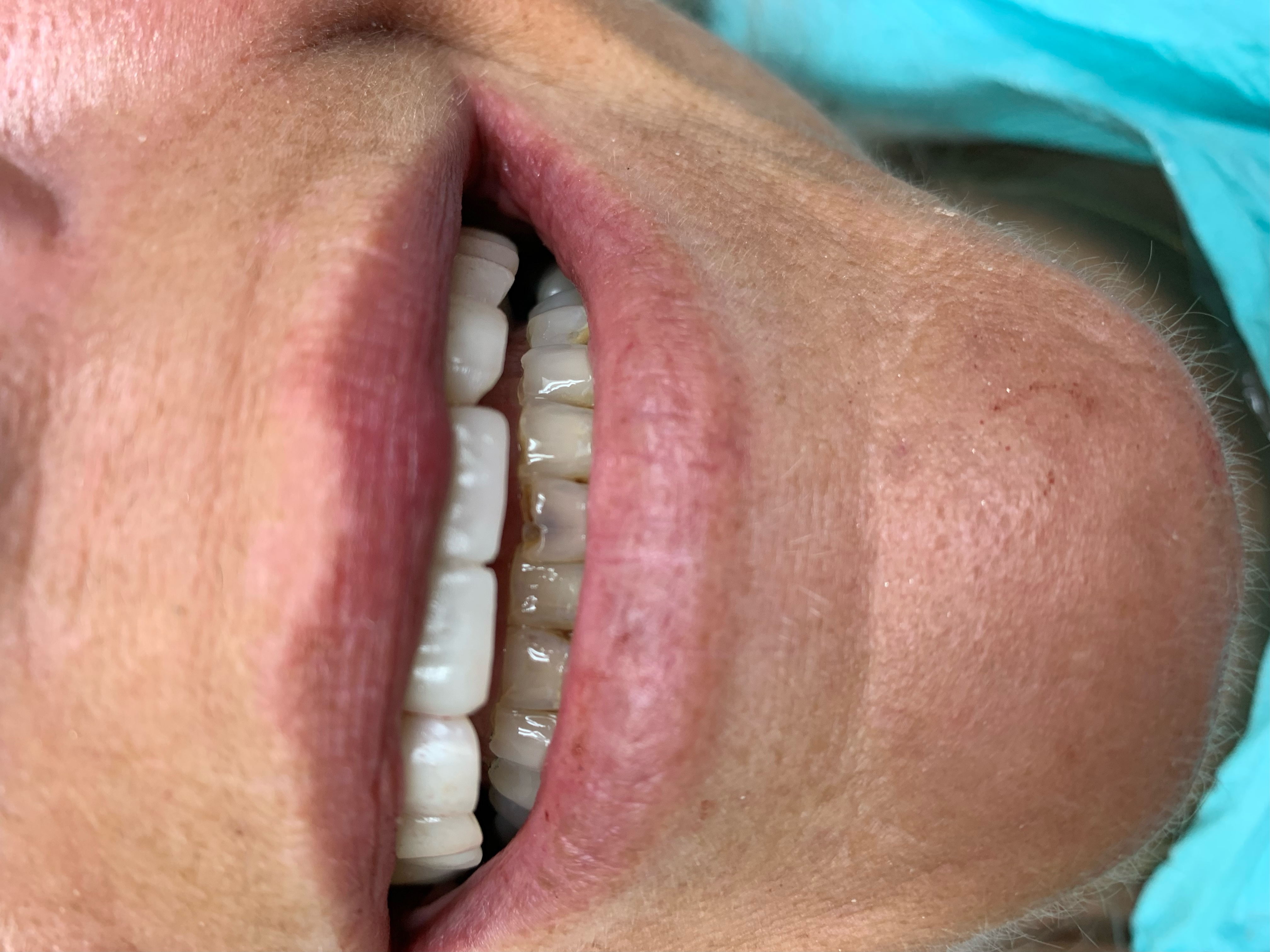 Before veneers